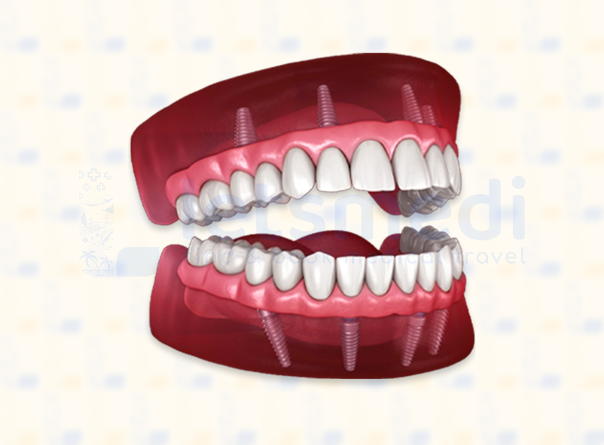 Full Mouth Dental Implants in Turkey • Cost & Reviews