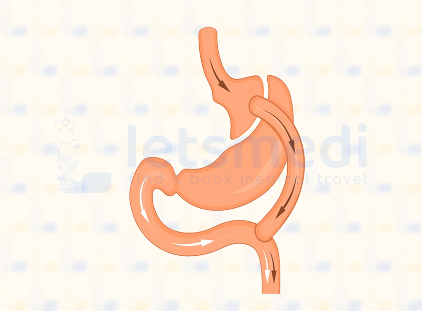 Gastric Bypass Istanbul, Turkey • Cost & Reviews