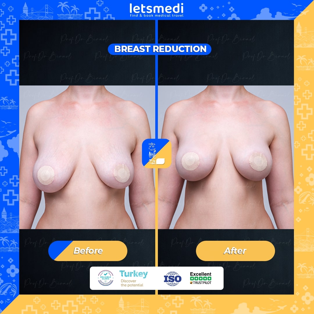 breast_reduction before after
