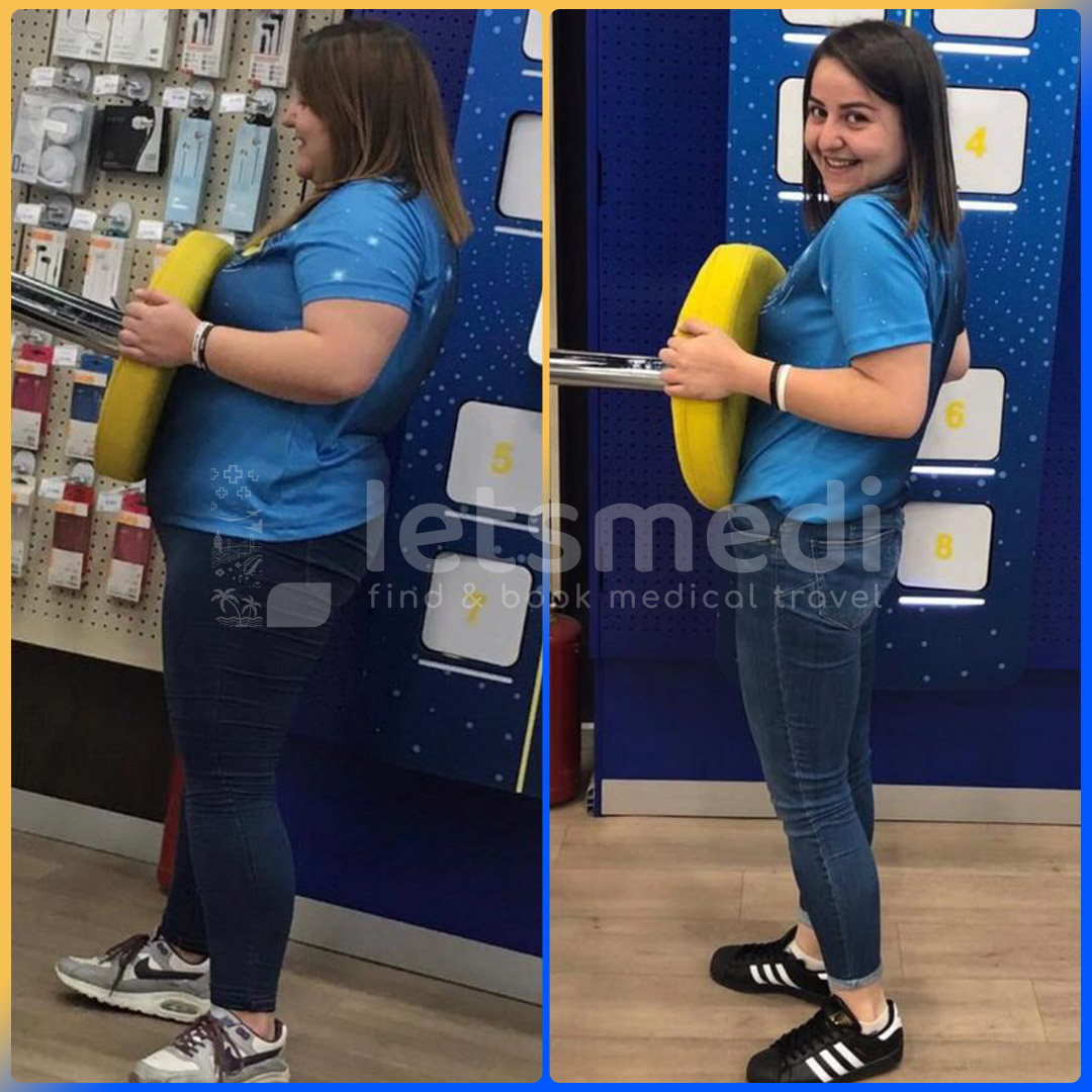 Before and after gastric sleeve in Turkey
