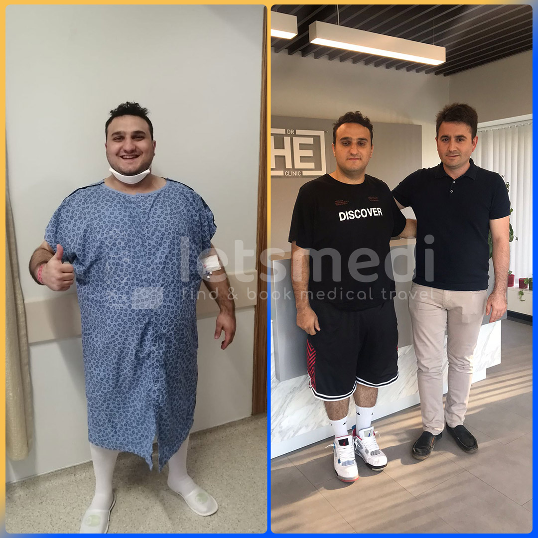 Before and after gastric sleeve in Turkey