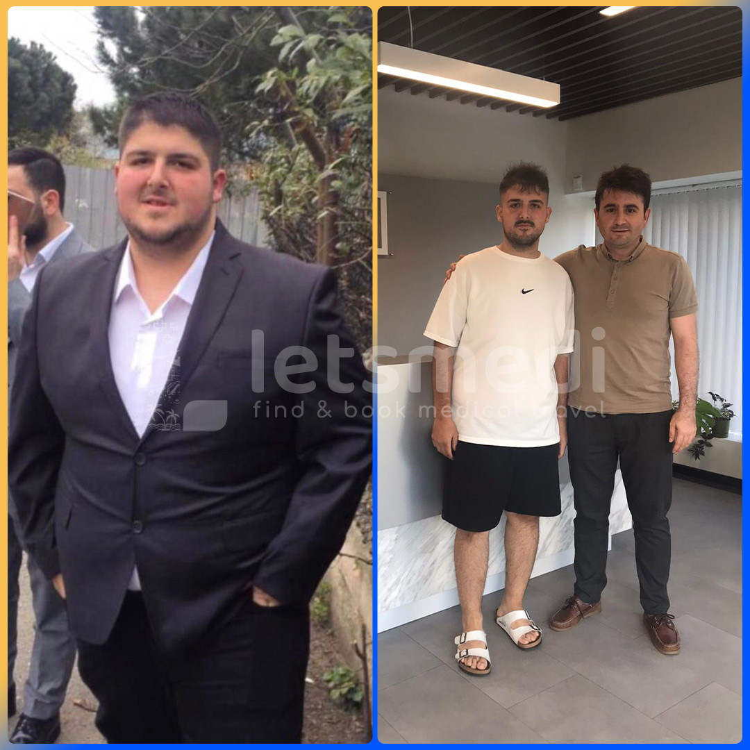 Before and after gastric sleeve in Turkey
