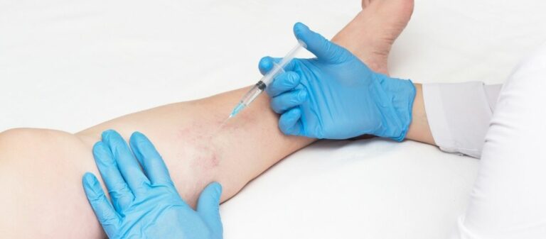 Varicose Vein Treatment Cost in the UK