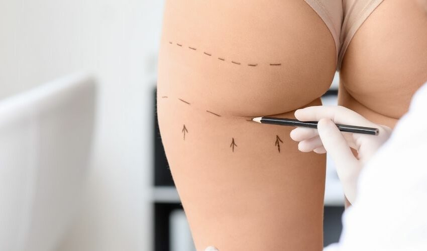Buttock Augmentation (Brazilian Butt Lift) Cost in the UK