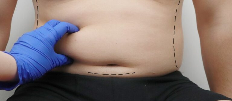 Circumferential Tummy Tuck Cost in the UK