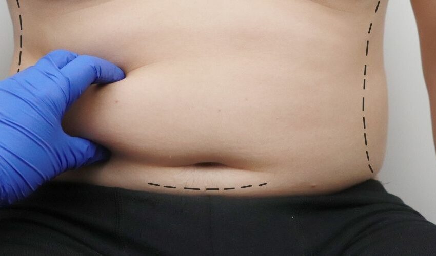 Circumferential Tummy Tuck Cost in the UK