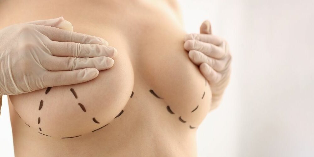 Fat Transfer Breast Augmentation Cost in the UK