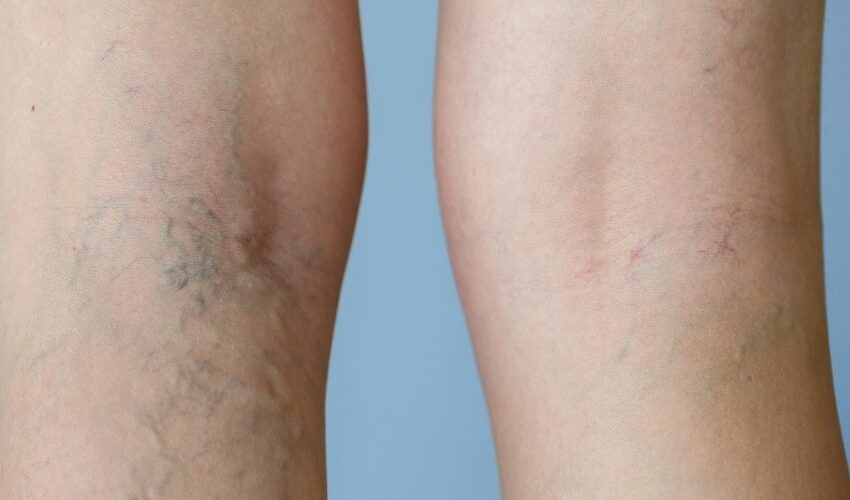 Laser Vein Removal Cost in the UK