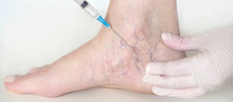 Sclerotherapy Cost in the UK