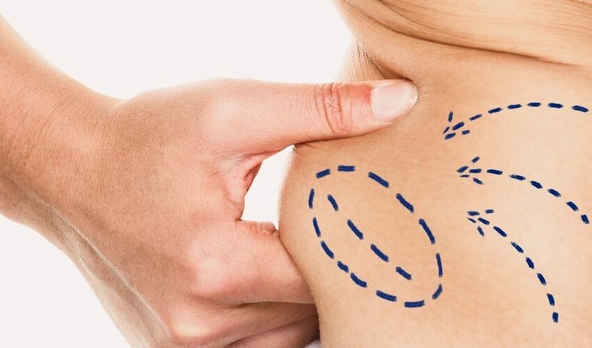 Tumescent Liposuction Cost in the UK