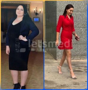 allurion gastric balloon before and after