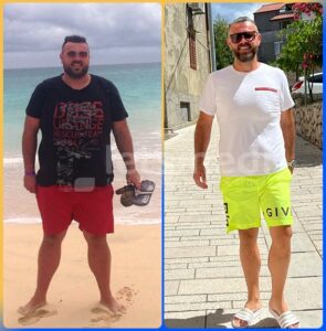 allurion gastric balloon before and after3