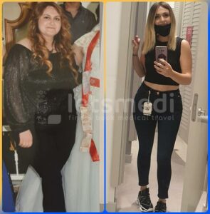 allurion gastric balloon before and after4