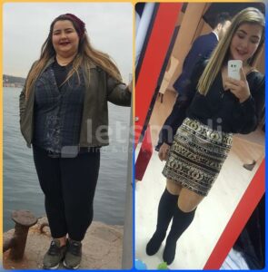 allurion gastric balloon before and after5