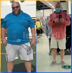 gastric bypass before after