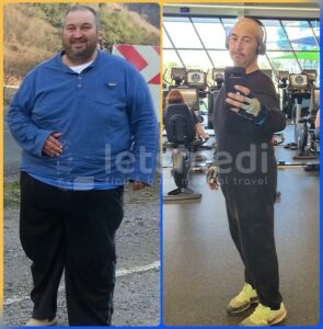 gastric bypass before after1