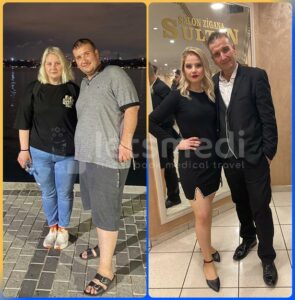 gastric bypass before after2