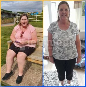 gastric bypass before after4