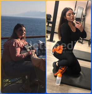 gastric sleeve in turkey before and after