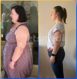 gastric sleeve in turkey before and after2