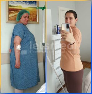 gastric sleeve in turkey before and after3