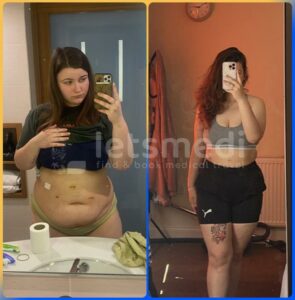 gastric sleeve in turkey before and after5