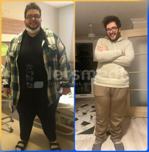 gastric sleeve in turkey before and after6