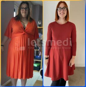 mini gastric bypass before and after