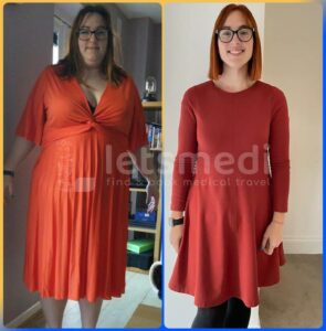 mini gastric bypass before and after
