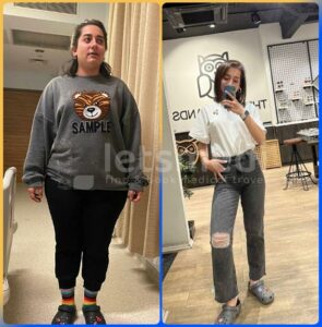 sleeve revison surgery before and after