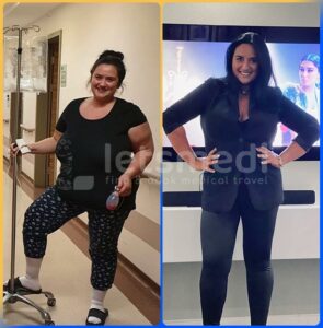 sleeve revison surgery before and after2